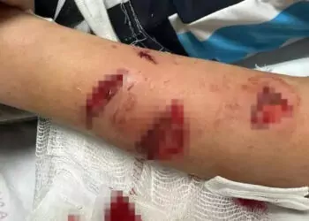 12 yaşındaki çocuk, sevdiği köpeğin saldırısında yaralandı