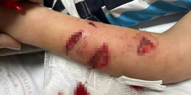 12 yaşındaki çocuk, sevdiği köpeğin saldırısında yaralandı