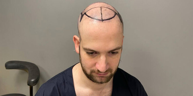 Amerikalı hastalar saç ektirmek için Türkiye'ye geliyor