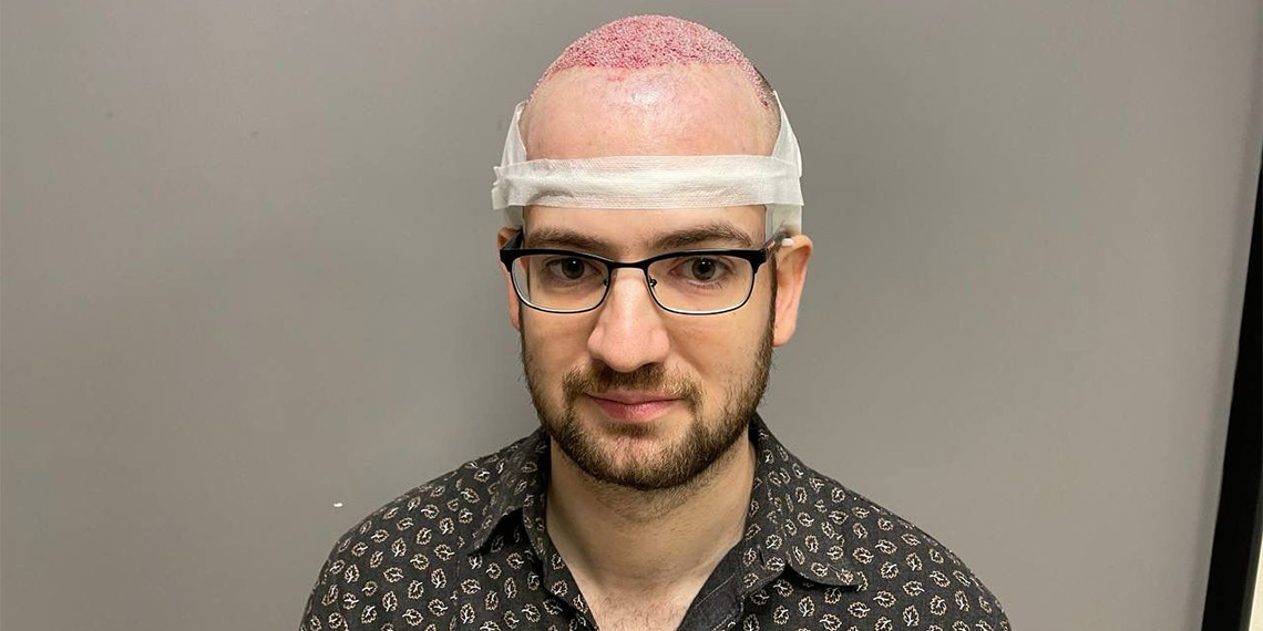 Saç ekimi merkezi Smile Hair Clinic’in kurucularından Dr. Mehmet Erdoğan, "Amerikalı hastalar saç ektirmek için Türkiye'ye geliyor, talep yüzde 150 arttı" dedi.