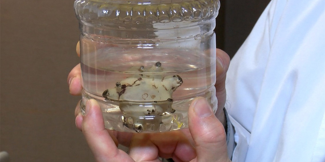 Mesanesinde oluşan 8 santimetrelik taştan ameliyatla kurtuldu