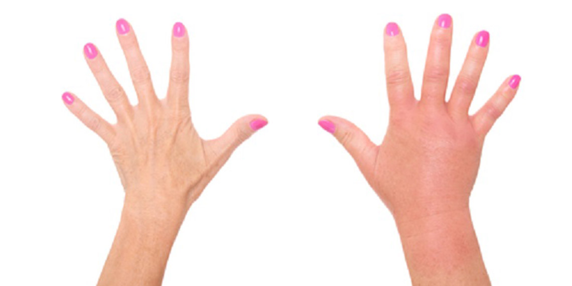 Ödemden kurtulmanın 7 yolu