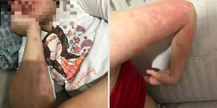 Eczacının verdiği muadil ilaç alerjik etki yaptı