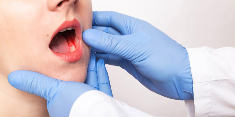 Uzun süreli yutkunma güçlüğü ağız kanseri işareti olabilir