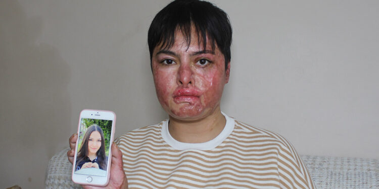 Vücudu yanan Beyzanur: Eski ben değilim artık