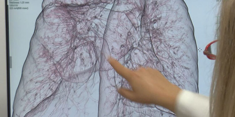 Akciğer kanseri tedavisinde yapay zeka desteği