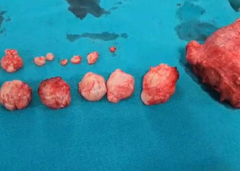 Rahminden 16 tümör çıkarıldı