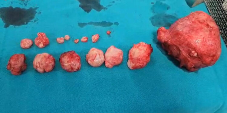 Rahminden 16 tümör çıkarıldı