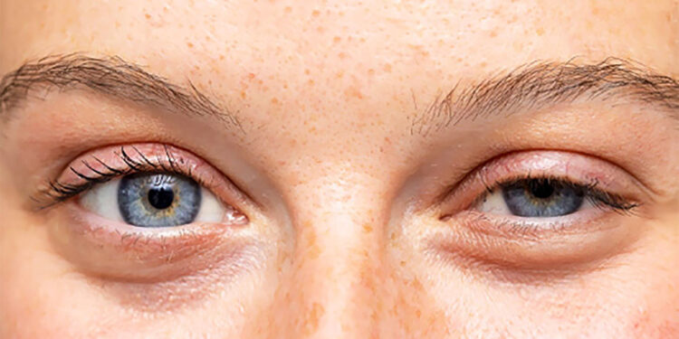 Düşük göz kapağı kaderiniz değil