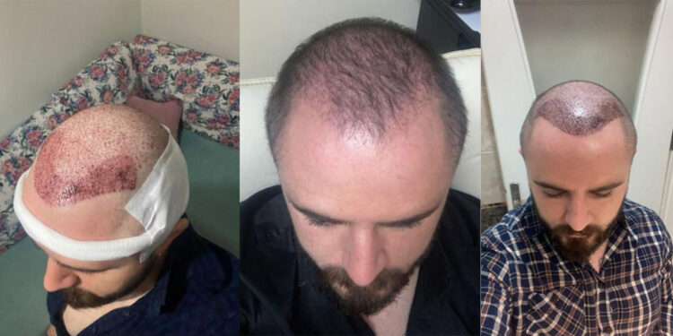 Avukata yapılan saç ekimi ayıplı işlem olarak kabul edildi