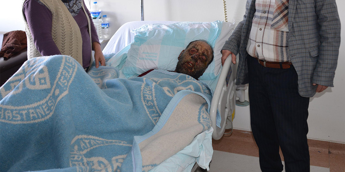 Pemfigus hastalığı, yüzünü tanınmaz hale getirdi