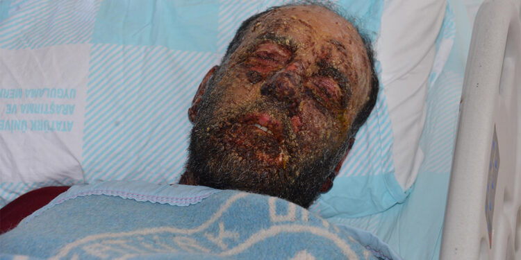 Pemfigus hastalığı, yüzünü tanınmaz hale getirdi