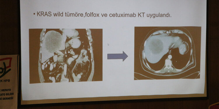 Kalınbağırsak kanseri nedeniyle dünyada 1 milyon kişi hayatını kaybediyor