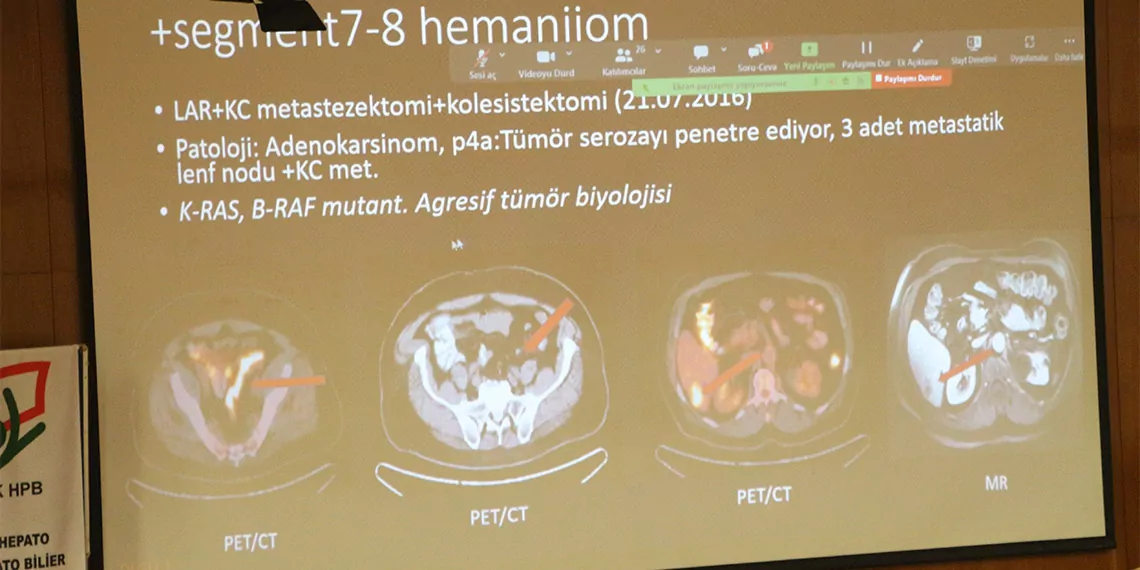 Türk hepato pankreato bilier (hpb) cerrahi derneği genel sekreteri prof. Dr. Gürkan tellioğlu, "görülme sıklığı 3'ncü sırada yer alan kalınbağırsak kanseri nedeniyle dünyada 1 milyon kişi hayatını kaybediyor" dedi.