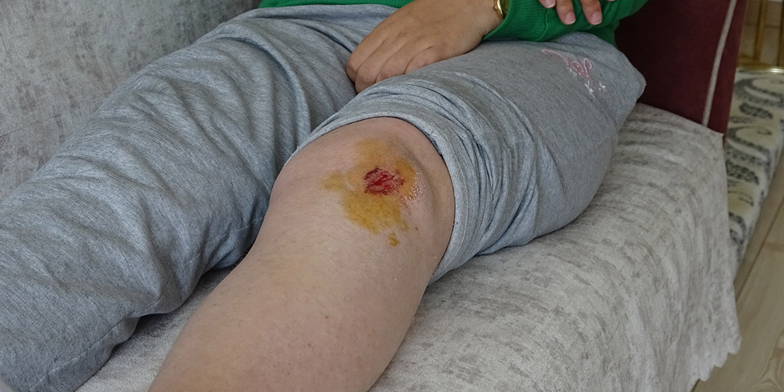 Köpeklerin saldırısına uğrayan liseli Özge yaralandı