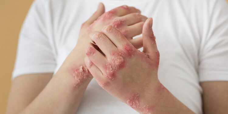 Uyuz hastalığı yaz aylarından çok sonbahar ve kışın görülüyor