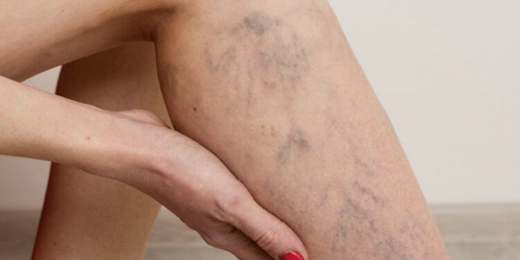 Varis tedavi edilmezse hayati risklere yol açabilir