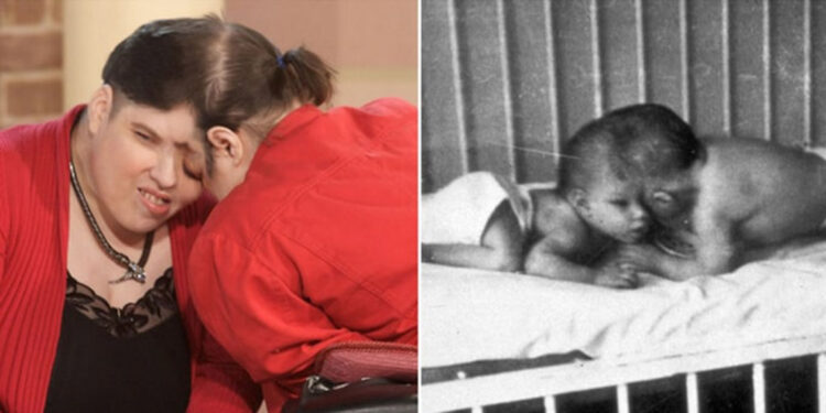 Dünyanın en yaşlı yapışık ikizleri hayatlarını kaybetti