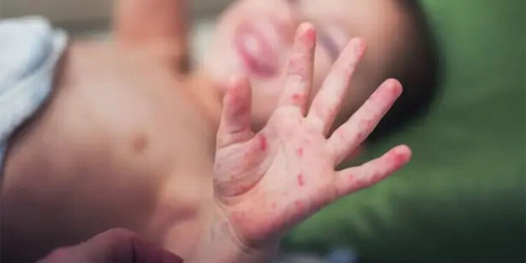 Çocuklarda görülen el ayak hastalığına dikkat!