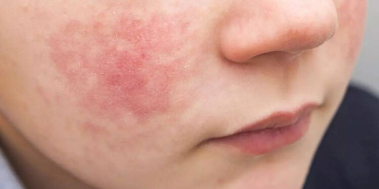 Çocuk enfeksiyonlarında bu kez 'Beşinci hastalık' gündemde