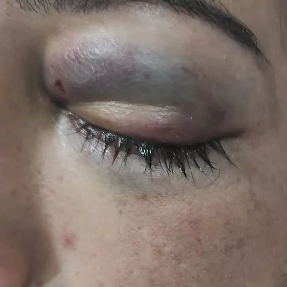 Eşinden şiddet görüp evi terk eden kadını, erkek kardeşi de dövdü