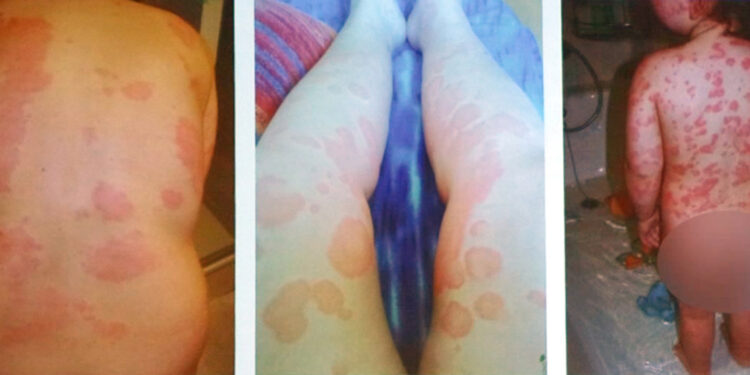 Kurdeşen kronikleştiğinde intihar riskine dahi yol açabiliyor