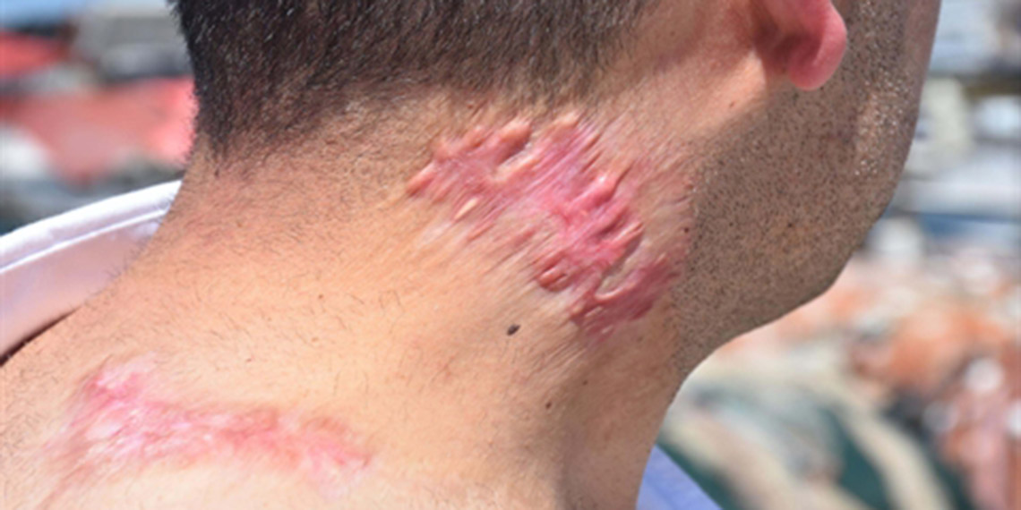 Lazer tedavisi sonrası 'yanık izi belirginleşti' suçlaması