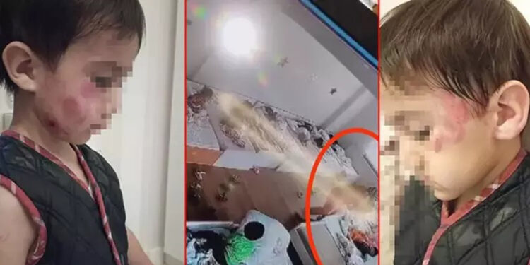 Anaokulunda dehşet! 4 yaşındaki çocuk arkadaşını uyurken 13 yerinden ısırdı