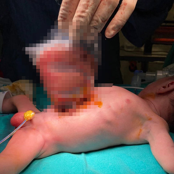 Bağırsakları dışarıda doğan Poyraz bebek, sağlığına kavuştu