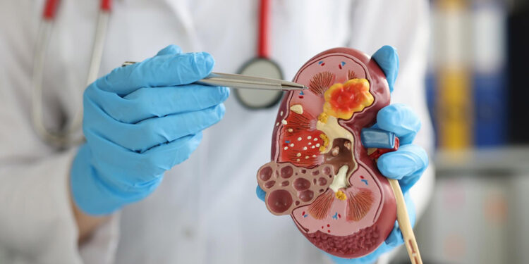 Böbrek taşı tedavi edilmezse böbrek kaybı yaşatabilir