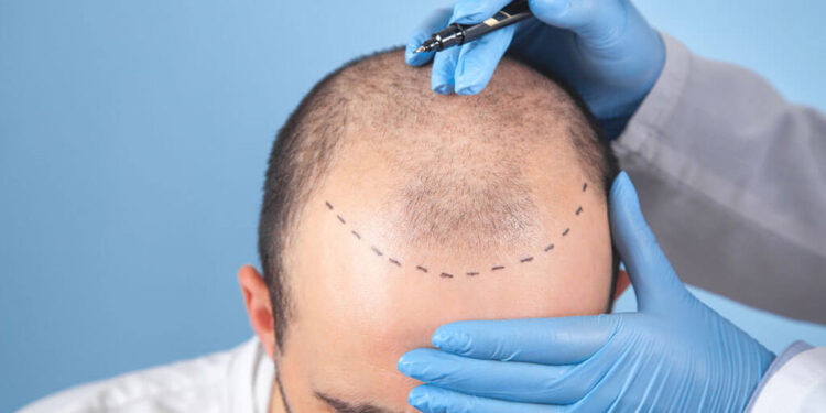 Yazın saç ektirenler 1 ay güneşin altında kalmasın