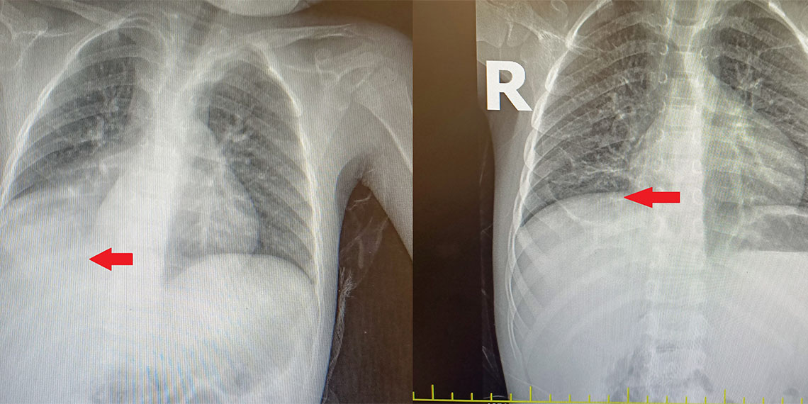 Doktorları bile şaşırtan vaka: 4 yaşındaki Abdullah Majzoub'un 3 yıl boyunca nefes borusunda karpuz çekirdeği ile yaşadığı anlaşıldı.