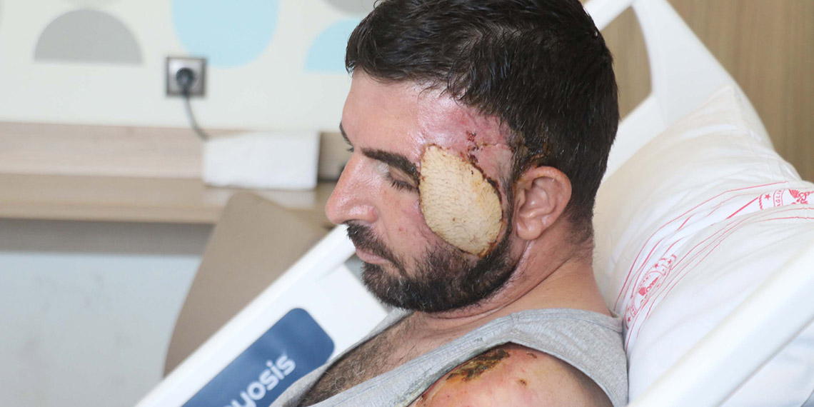 Çocuklarını kurtarmak için otomobilinin önüne atlayan babanın yüzüne doku nakli