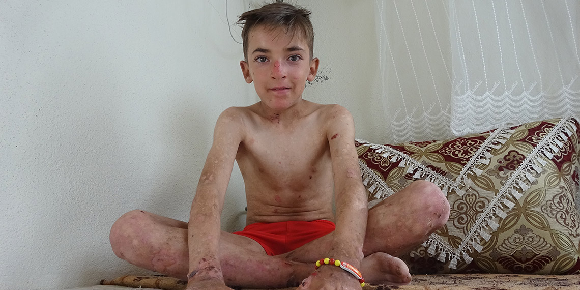 Deri hastası Amar: Arkadaşlarım benimle dalga geçiyor