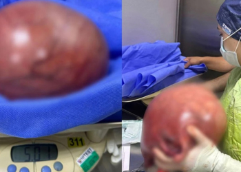 Kilo aldığını sandı, rahminden 5 kilo kitle çıktı
