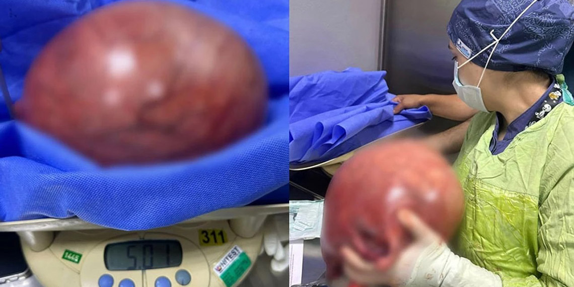 Kilo aldığını sandı, rahminden 5 kilo kitle çıktı