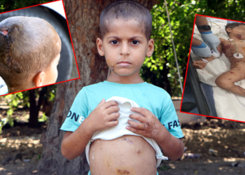 Sokak köpeklerinin saldırdığı 5 yaşındaki Abbas: Çok korktum