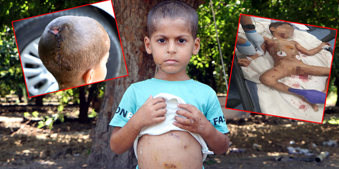 Sokak köpeklerinin saldırdığı 5 yaşındaki Abbas: Çok korktum