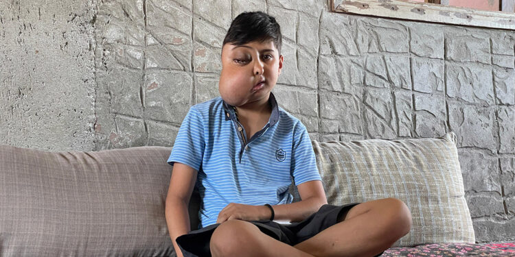 Yüzündeki kitle her geçen gün büyüyen Enes, sağlığına kavuşmak istiyor