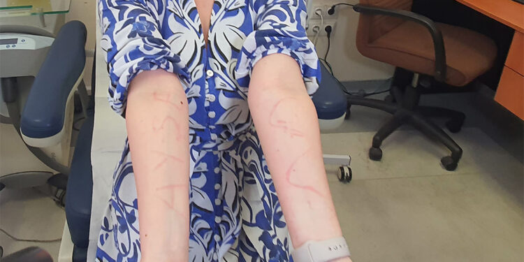 Kurdeşen hastaları canından bezdiriyor