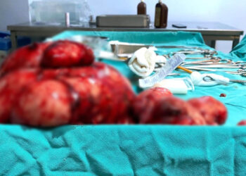 Yıllarca karnındaki 10 kiloluk kitleyle yaşamış