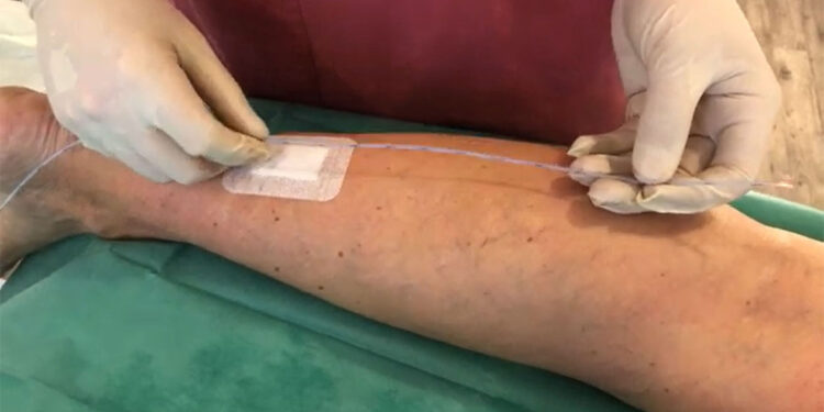 Almanya'da güvenli varis tedavisi