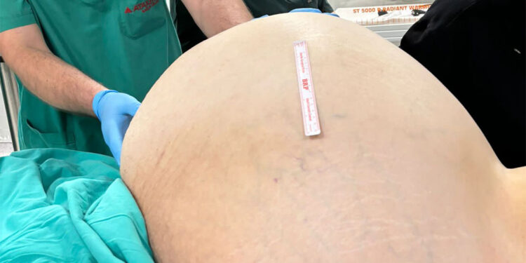 Yumurtalıklarındaki 23 kiloluk kitle operasyonla çıkarıldı