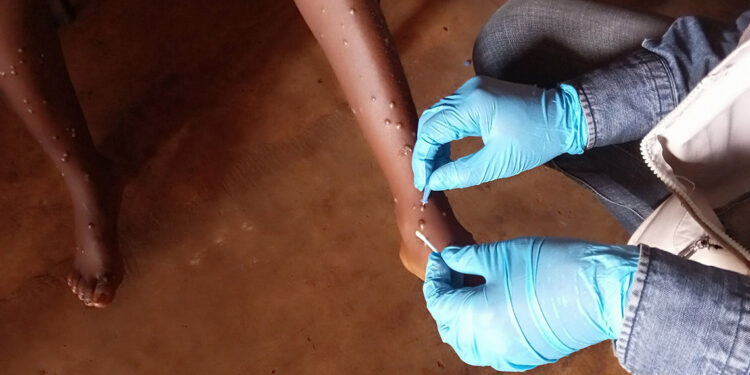 AB: Maymun çiçeği virüsünden etkilenen bölgelere 215 bin doz aşı göndereceğiz