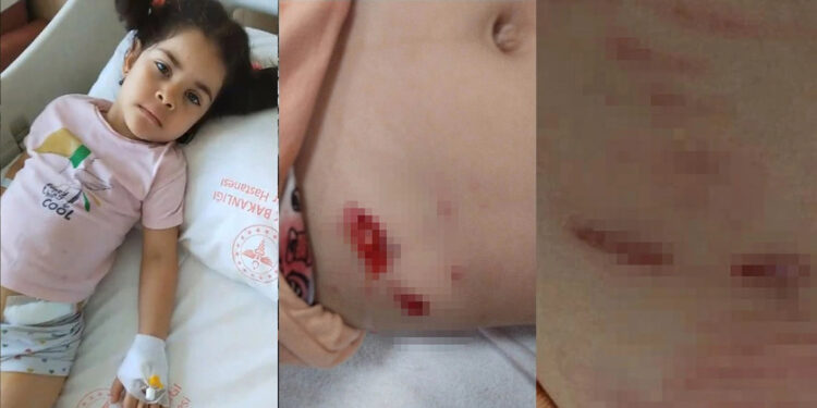 Ankara'da başıboş köpeklerin saldırısına uğrayan Elif, yaralandı