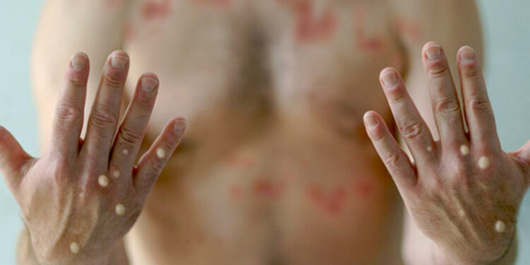 Bakanlık açıkladı: Maymun çiçeği vakası Türkiye'de görüldü mü?