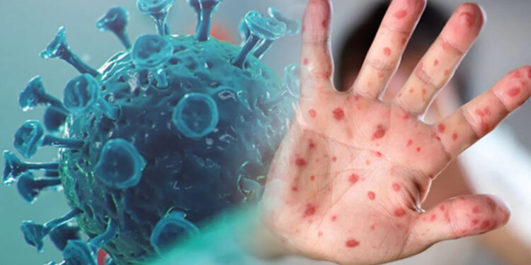 Halsizlik, baş ağrısı ve ateş; maymun çiçeği virüsünün belirtileri olabilir