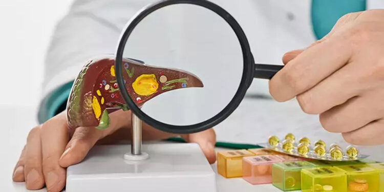 Her 3 kişiden birinde karaciğer yağlanması olduğu tahmin ediliyor