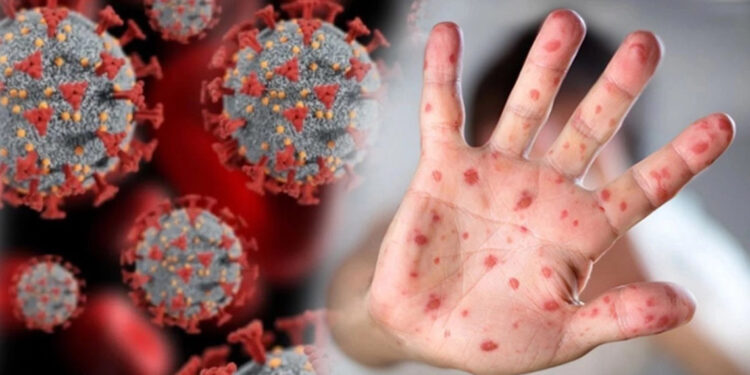 Uzmanından 'maymun çiçeği' uyarısı: Cilt lezyonu olanlara doğrudan temas edilmemeli