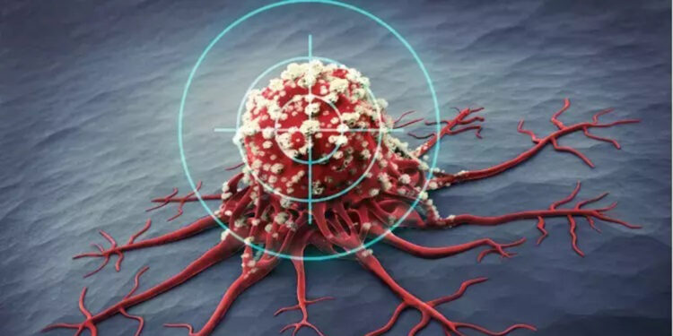 Yapay zekâ ile prostat kanserinde daha erken teşhis mümkün